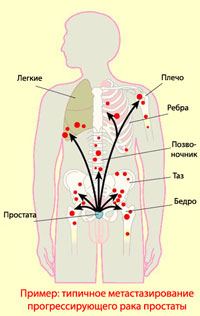 Метастазирование рака простаты